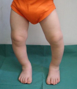 درمان زانو (پا) پرانتزی بدون جراحی در کودکان
